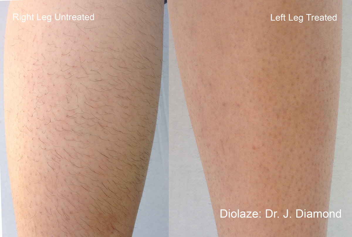 DiolazeXL laser treatment Before and After Bonita Springs