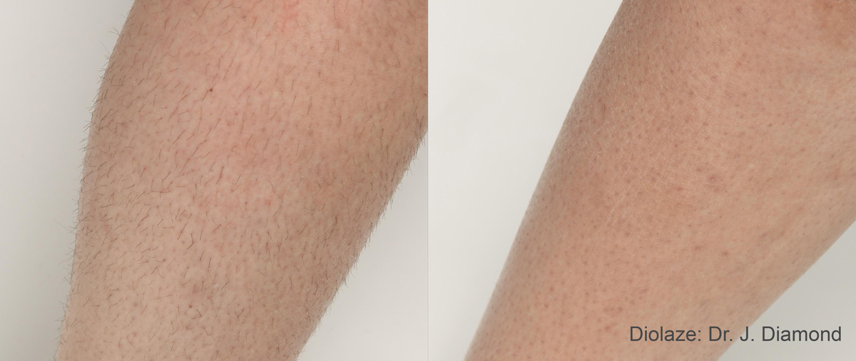 DiolazeXL laser treatment Before and After Bonita Springs