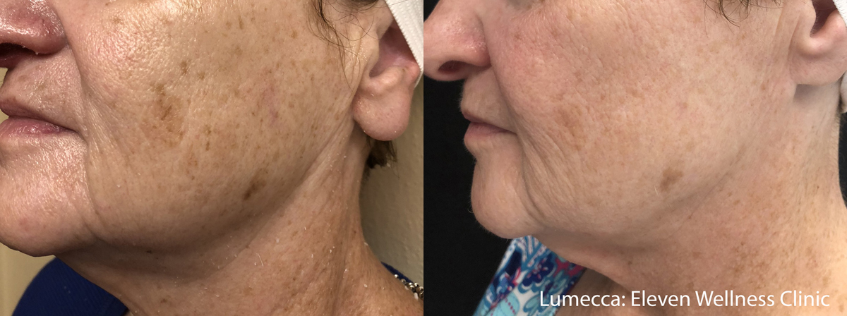 Lumecca Before & After Photo Bonita Springs, Estero, Fort Myers, and Naples