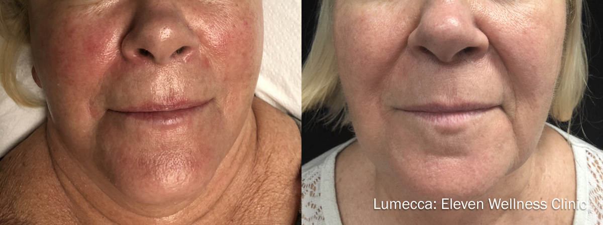 Lumecca Before & After Photo Bonita Springs, Estero, Fort Myers, and Naples