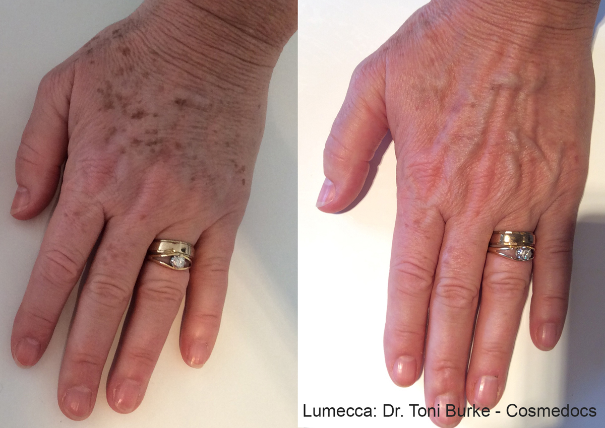 Lumecca Before & After Photo Bonita Springs, Estero, Fort Myers, and Naples