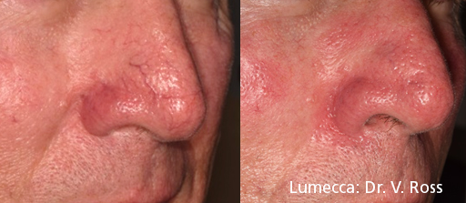 Lumecca Before & After Photo Bonita Springs, Estero, Fort Myers, and Naples
