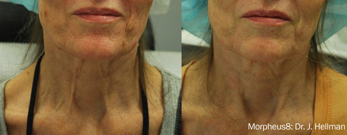 morpheus8-lower-face-before-and-after