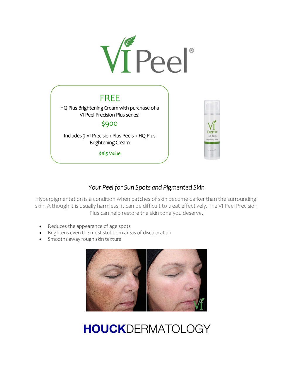 vi-peel-special