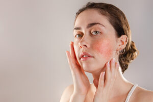 young woman with rosacea on her cheeks