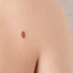 Close-up of a mole on a person's back