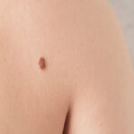 close-up-of-a-mole-on-a-persons-back