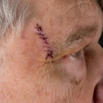 Close-up of surgical sutures on an elderly person's forehead near the eyebrow following a medical procedure.