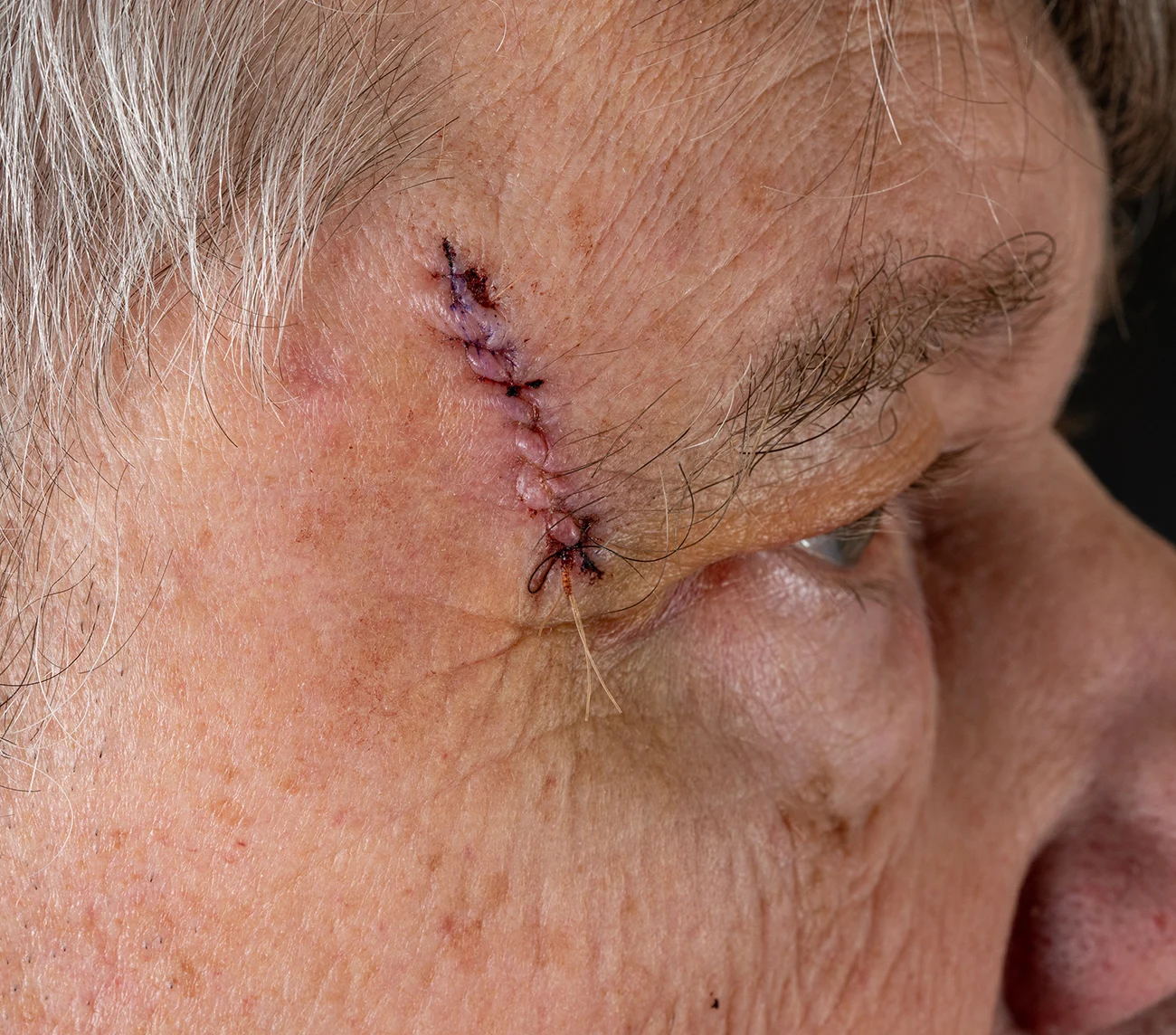 Close-up of surgical sutures on an elderly person’s forehead near the eyebrow following a medical procedure.